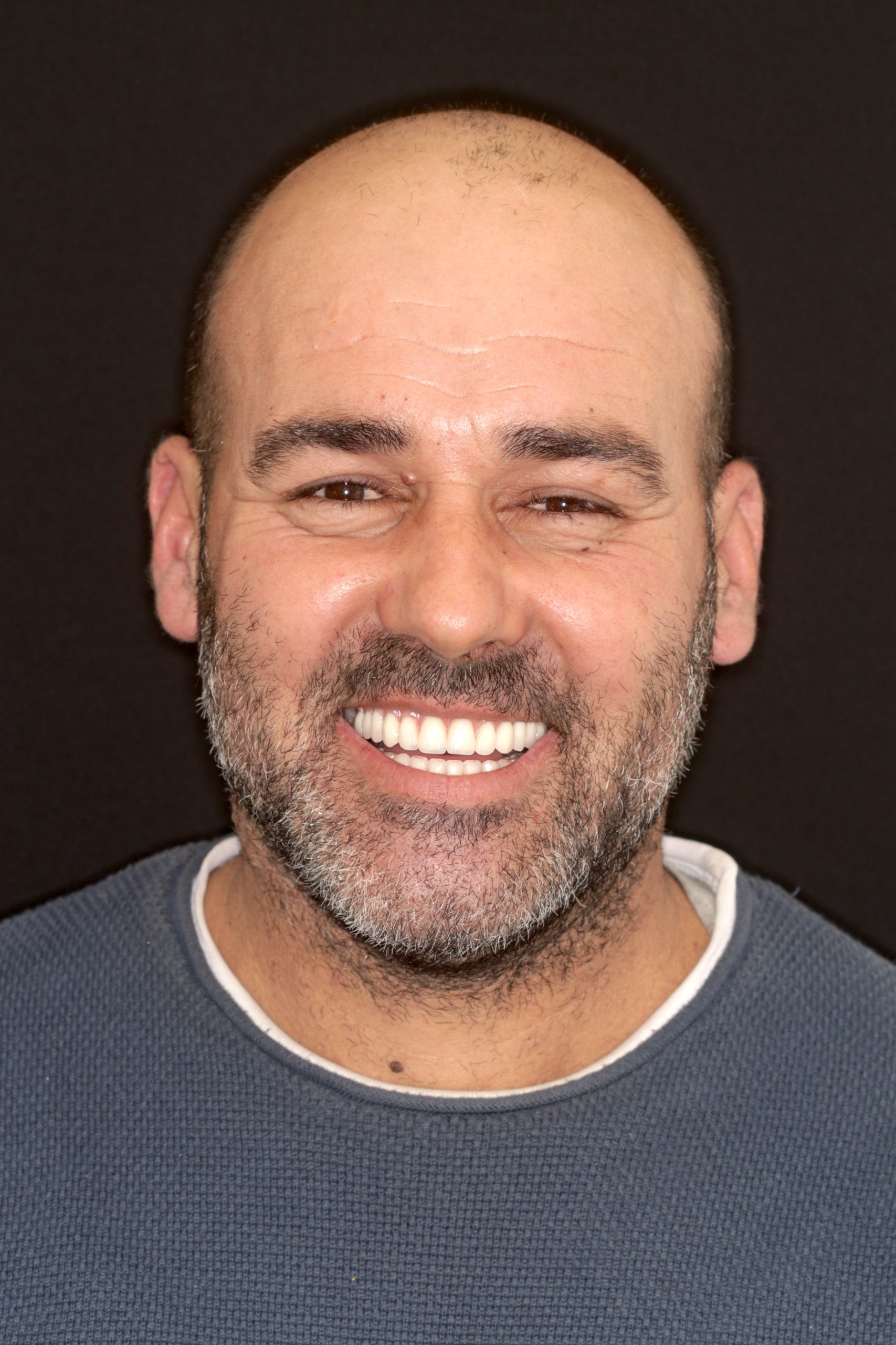 implantes dentários