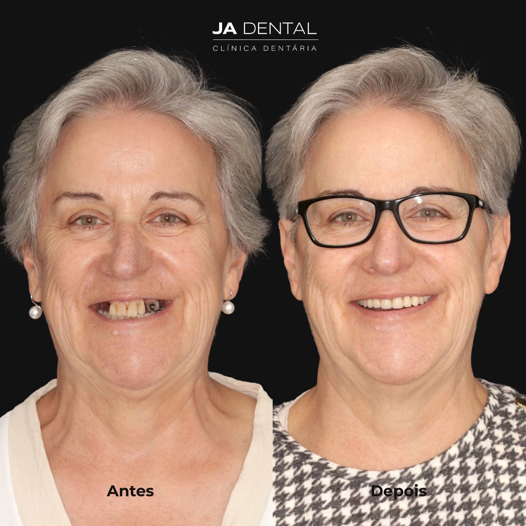 prótese fixa antes e depois