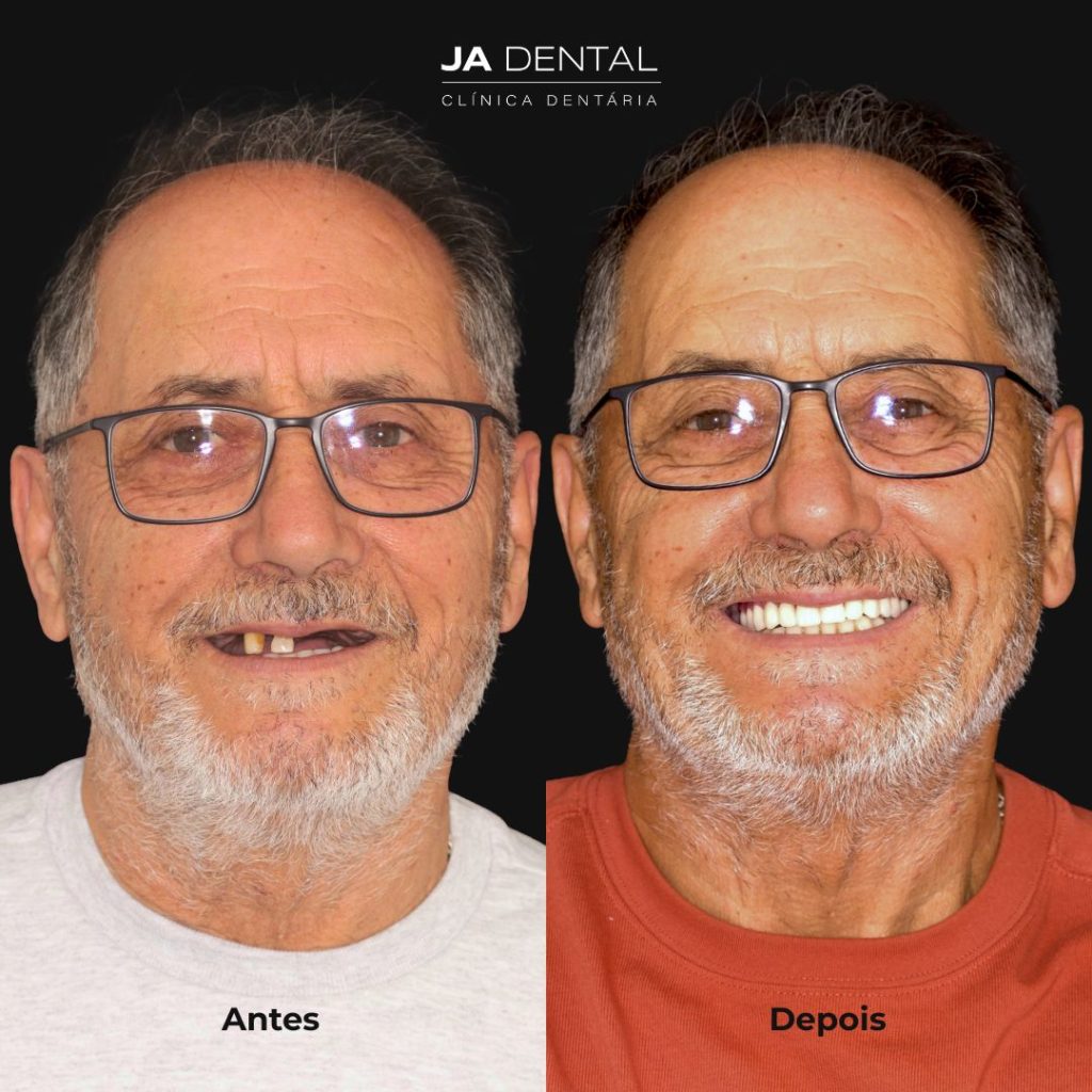 prótese fixa antes e depois
