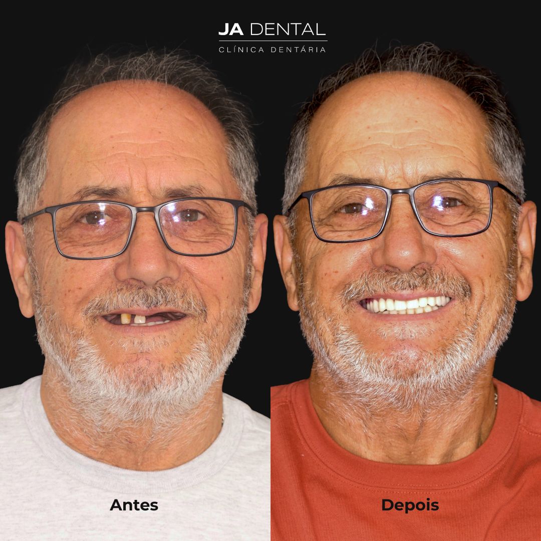 prótese fixa antes e depois