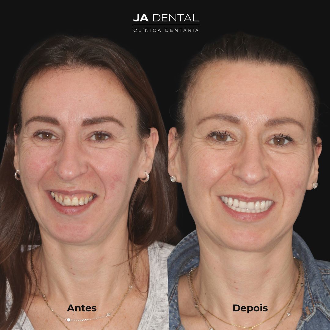 prótese fixa antes e depois