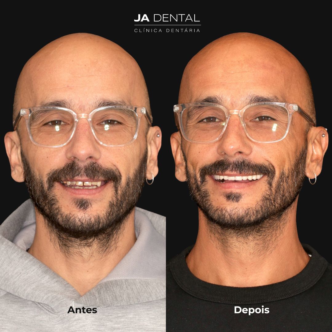 prótese fixa antes e depois