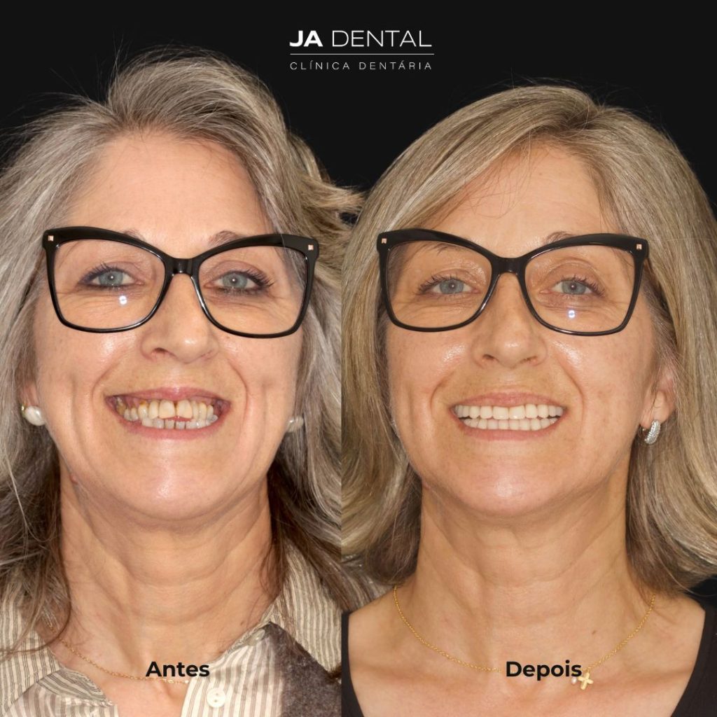 prótese fixa antes e depois