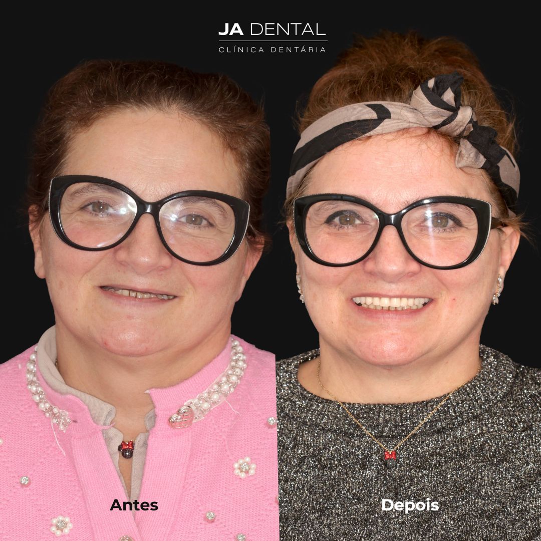 prótese fixa antes e depois