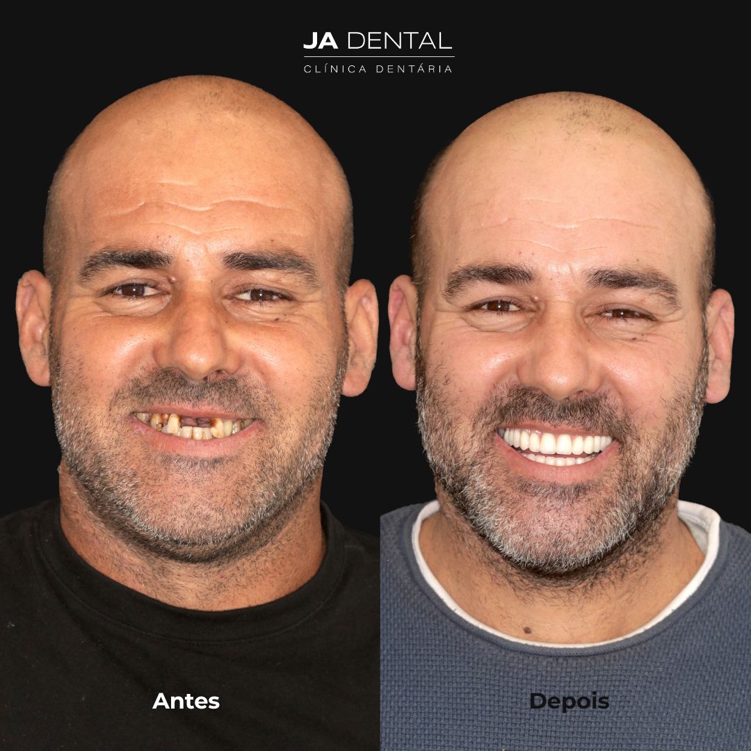 prótese fixa antes e depois