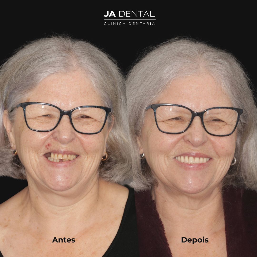 prótese fixa antes e depois
