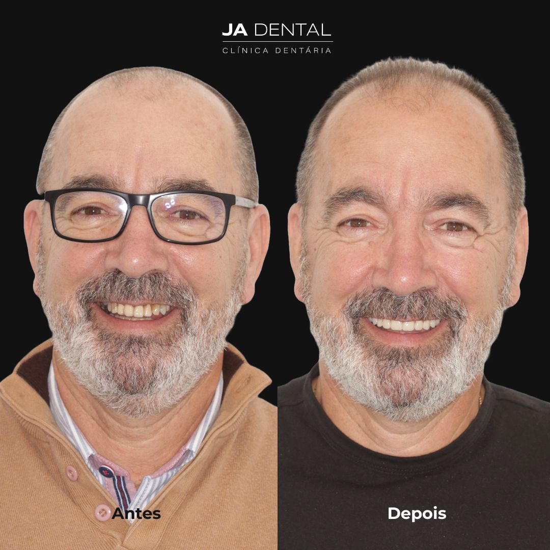 prótese fixa antes e depois