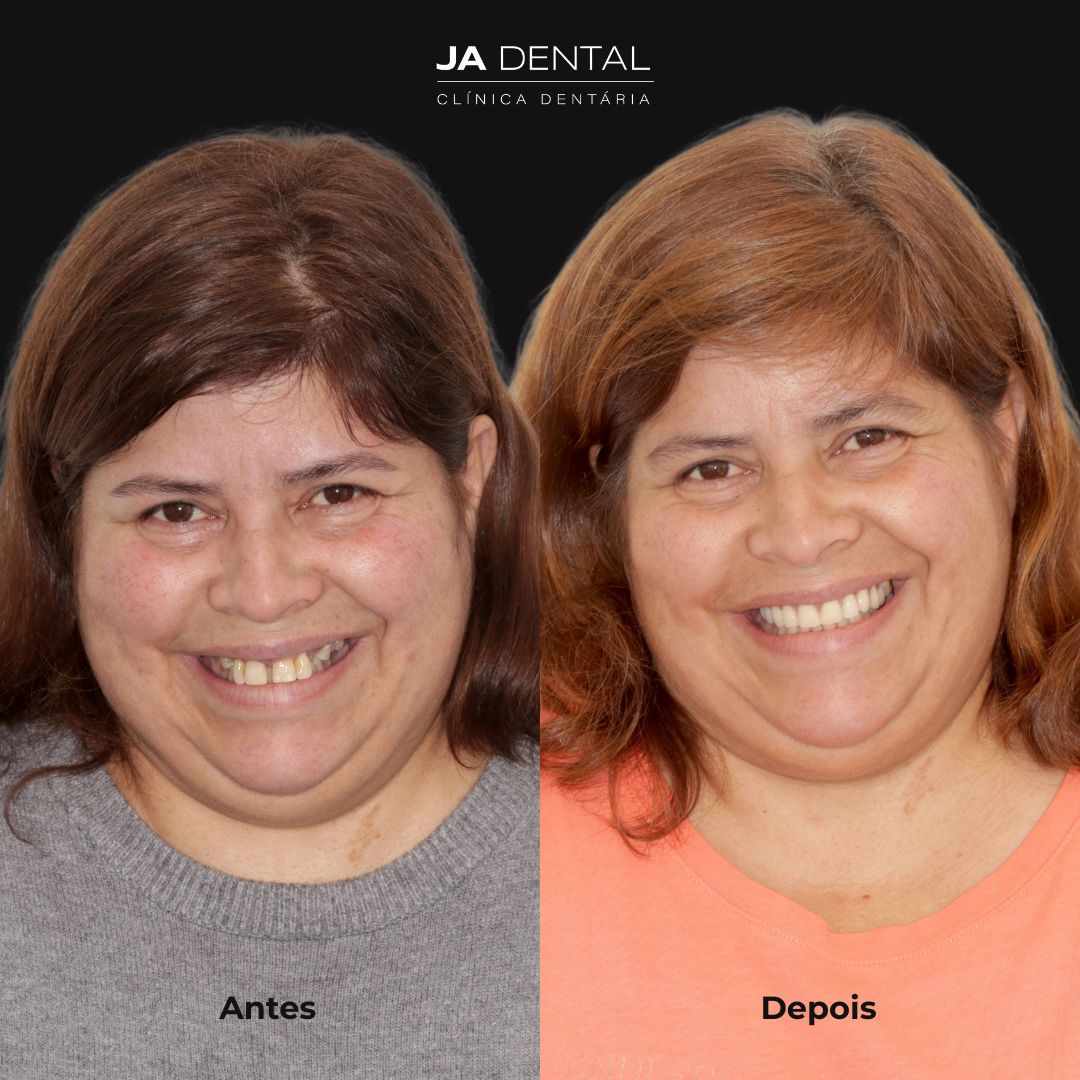 prótese fixa antes e depois