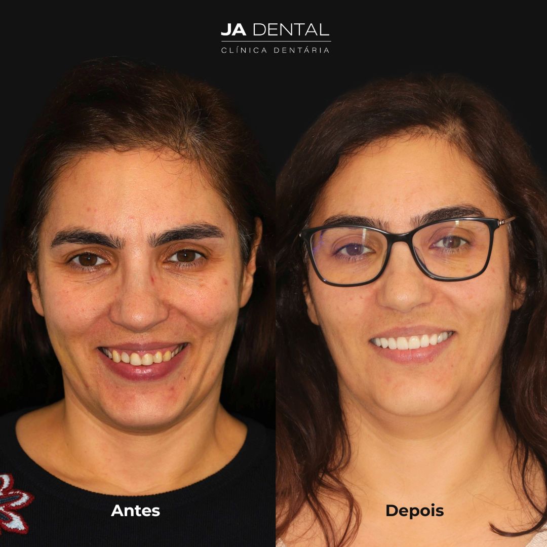 facetas antes e depois