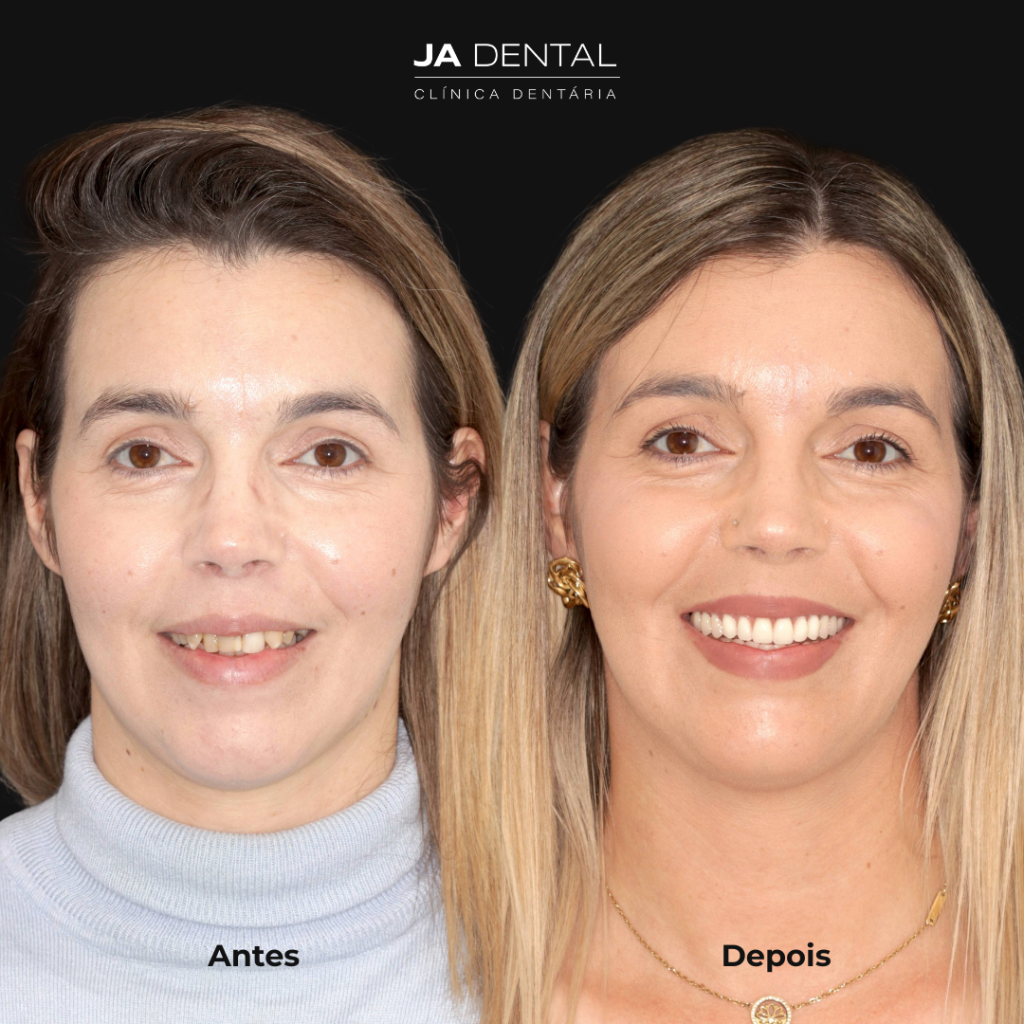 prótese fixa antes e depois