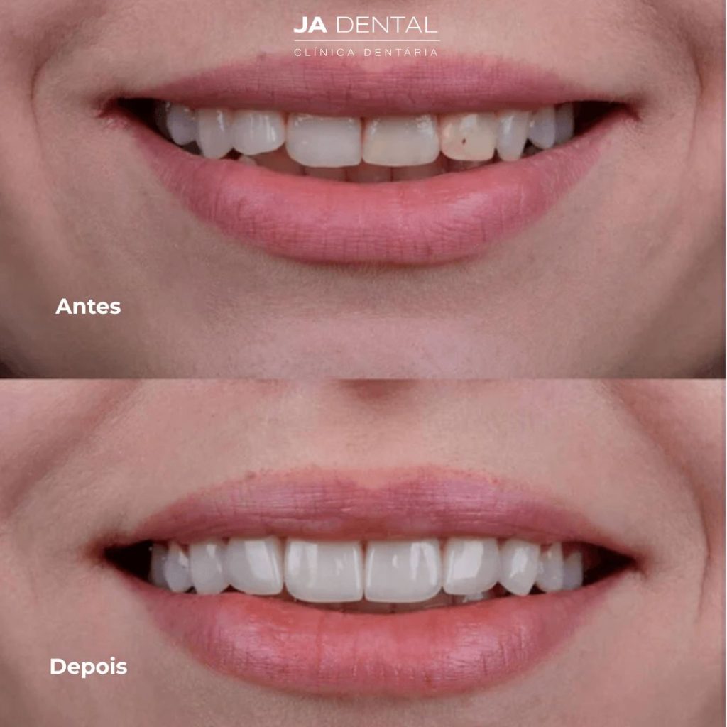 facetas dentárias antes e depois