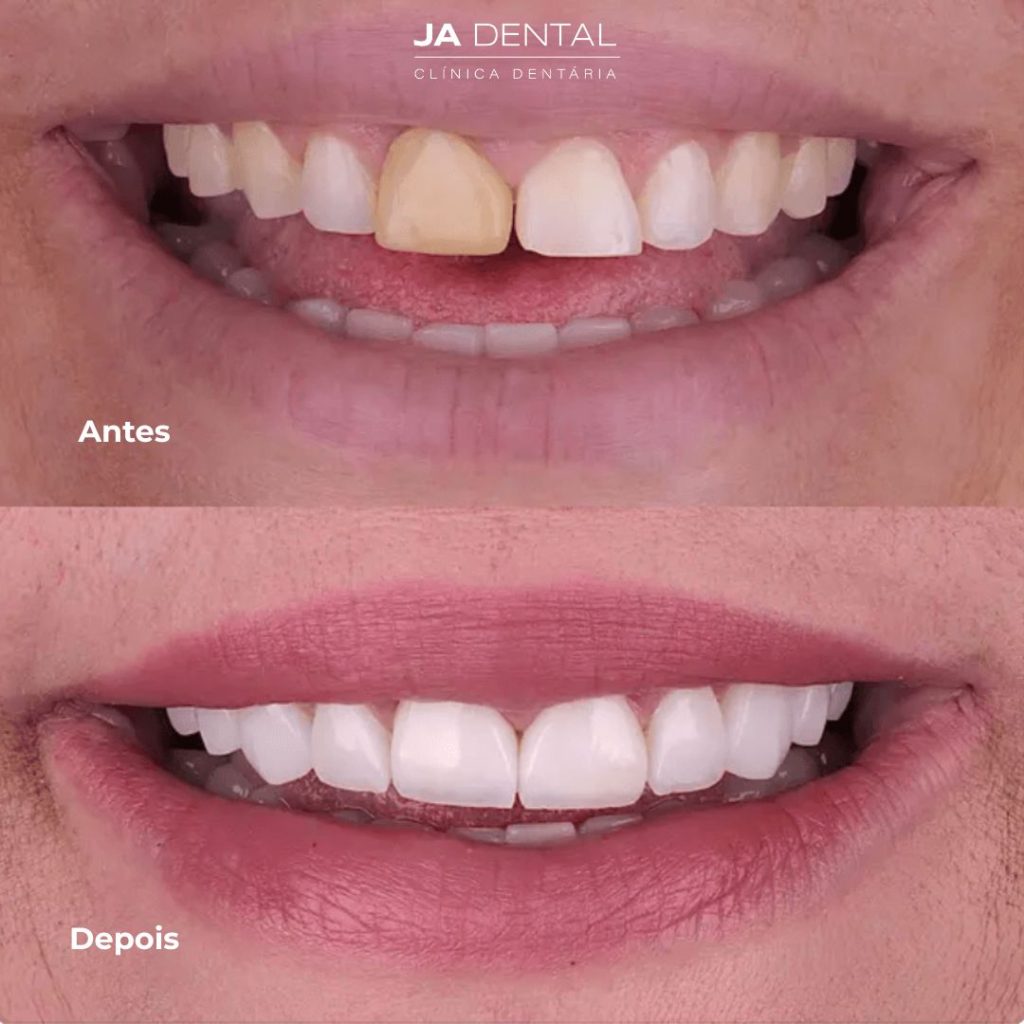 facetas dentárias antes e depois