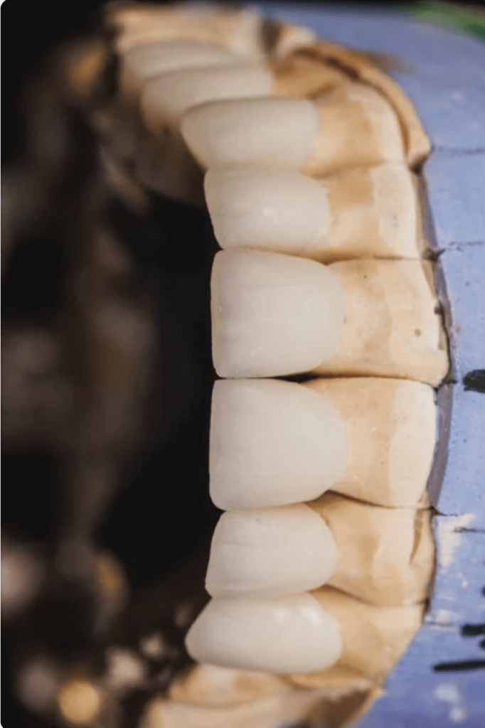 facetas dentárias