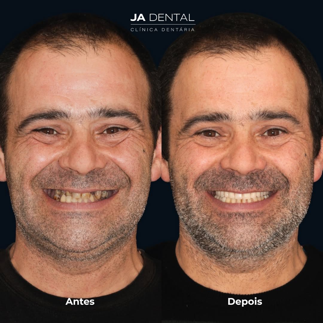 prótese fixa sobre implantes