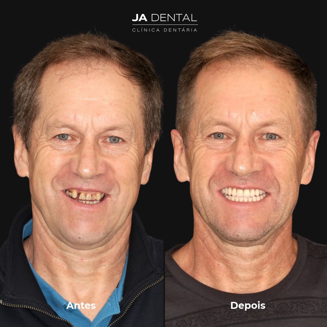 prótese fixa antes e depois