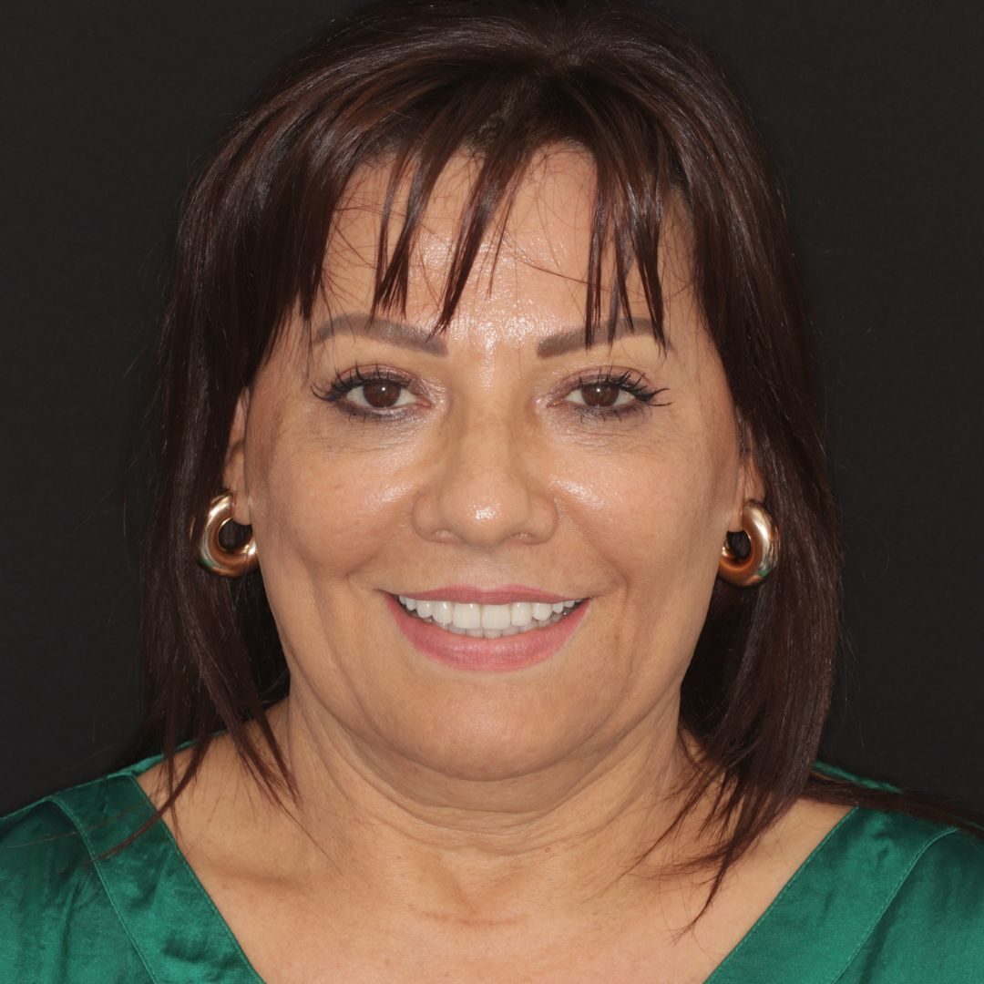facetas dentárias